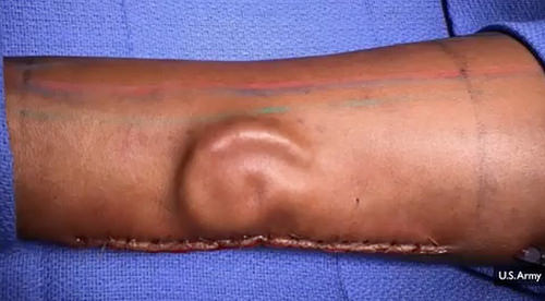 Army Doctors Grew a Soldier a New Ear --- On Her Forearm [click for article and video story]