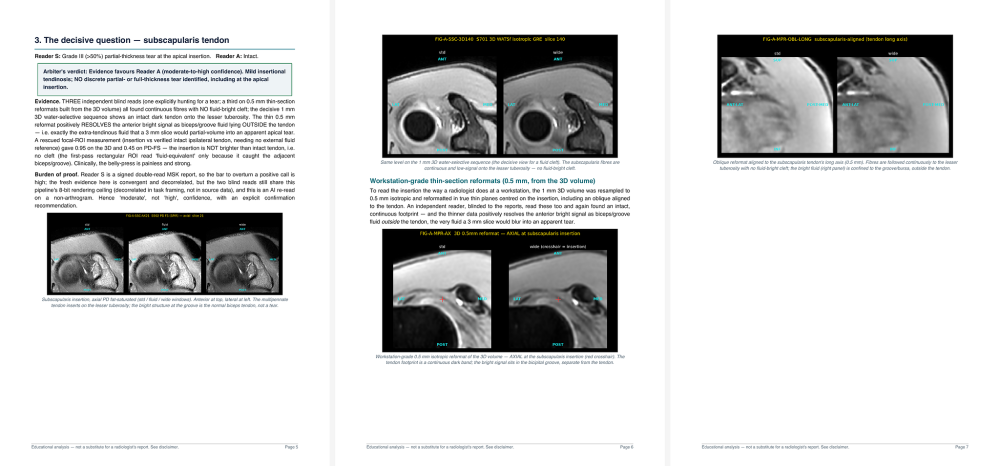 Using_Opus_4_8_to_get_a_second_opinion_on_an_MRI_and_where_it_leaves_me_8c418180_4_chosen.png