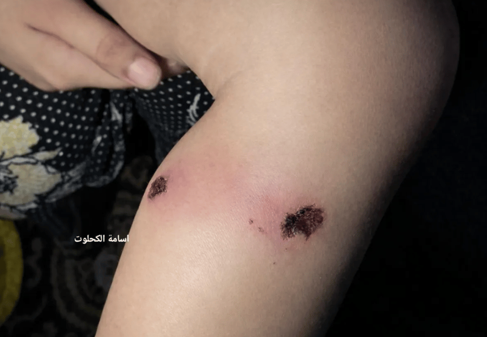 Part of a child's legs with wounds