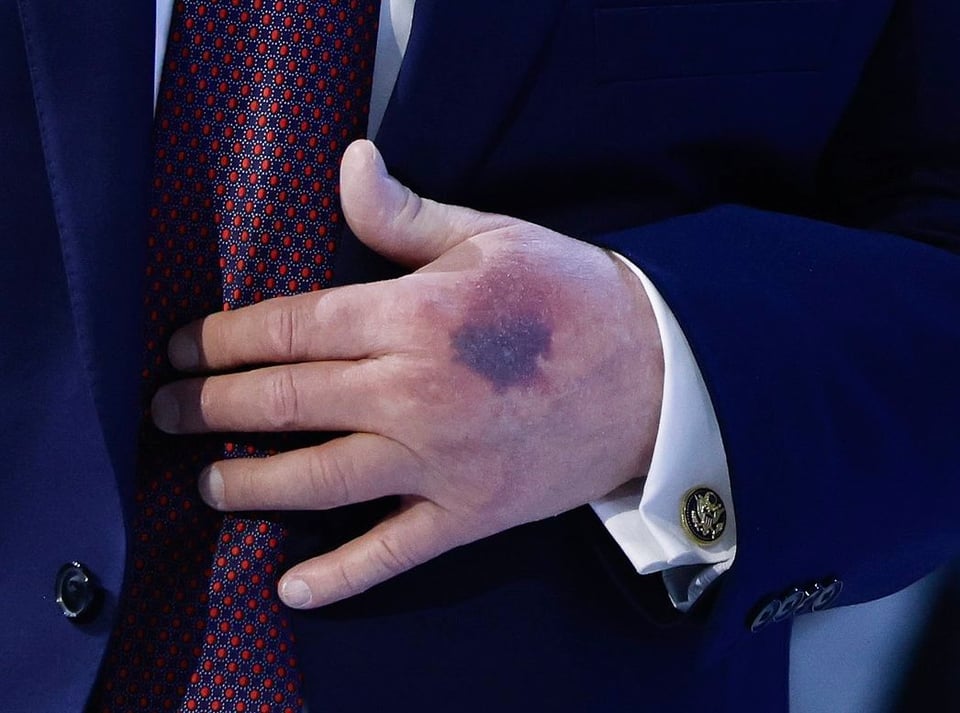 Trump’s hand at Davos