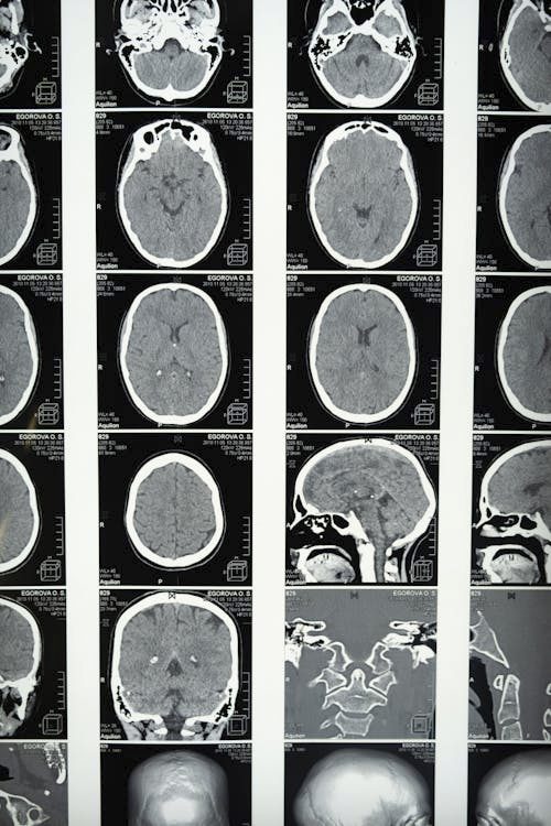 A grid of black and white MRI images of a head, showing various views of the brain