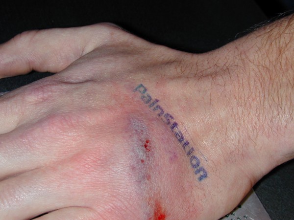 Hand with PainStation temporary tattoo and whip bruising