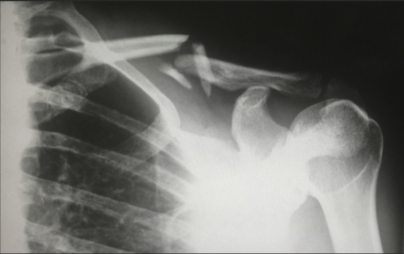 On Payola and X-rays: Part 1