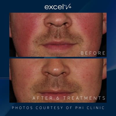 patient photos before and after treatment with excel v+