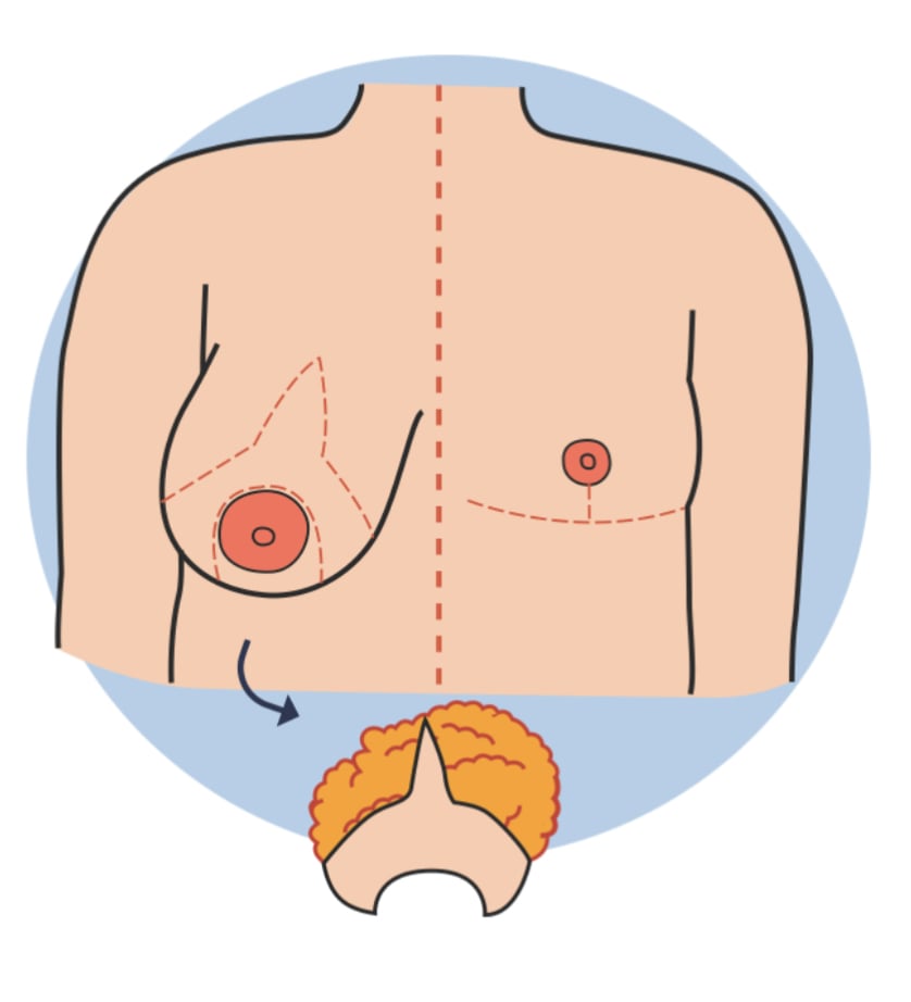 Illustration of breast reduction