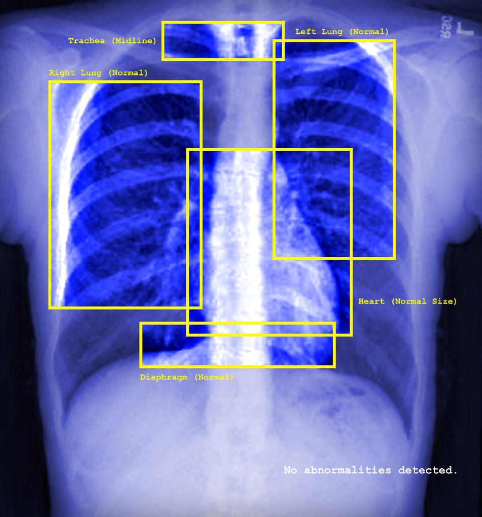 This image shows a blue xray image of a person's chest - it shows the ribs, the faint outline of a heart, and other organs. The image features yellow squares surrounding the organs (left lung, trachea, right lung, heart, diaphragm) - each of them feature labels such as: normal, midline, normal size. There is text in the right bottom corner in white which states 'no abnormalities detected'.