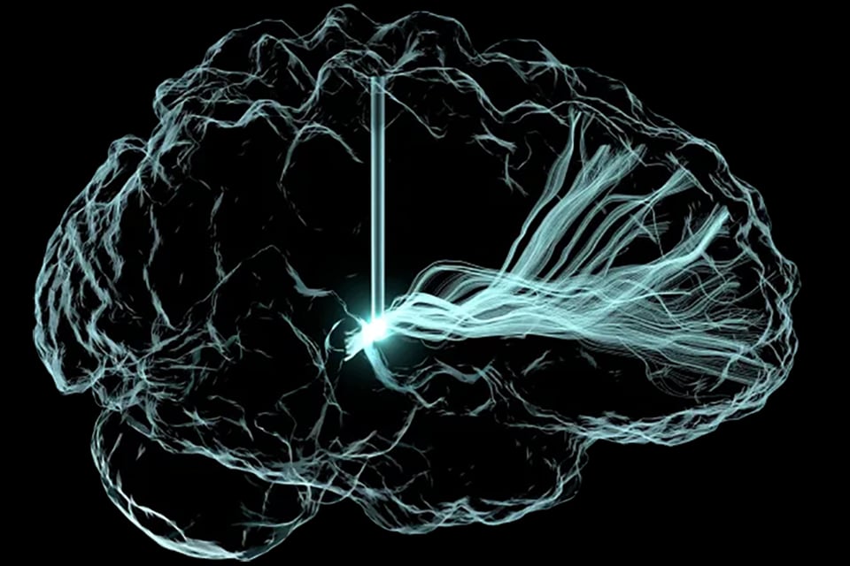Artist's rendering of a brain with an electrode stimulating pathways to treat patients with traumatic brain injury