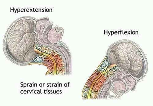 An image of neck hyperextension and hyperflexion, which can both lead to sprain or strain of cervical (neck) tissues